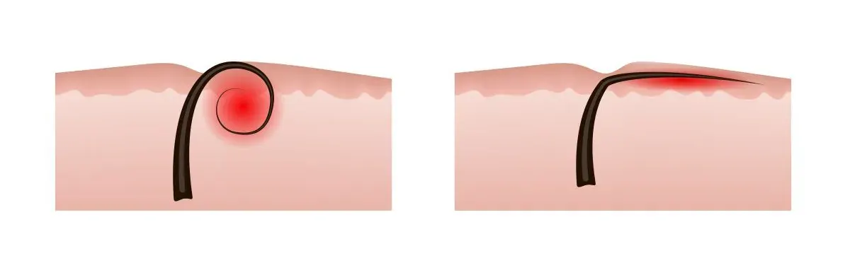Diagram of two ingrown hairs in a cross-section of skin: on the left a hair curls back into the skin, on the right a hair grows sideways just under the surface; both are marked with a red, inflamed area.