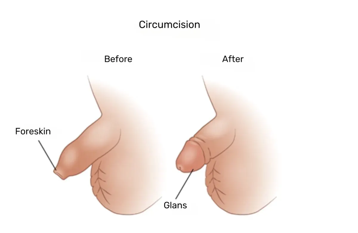 Drawing of a penis before and after circumcision: before, the foreskin covers the glans; after, the glans is exposed.